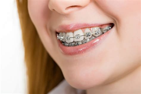 metal brackets in orthodontics|traditional metal braces for adults.